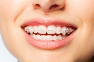 Types of Braces OMI Orthodontics Orthodontist in Fort Wayne, IN